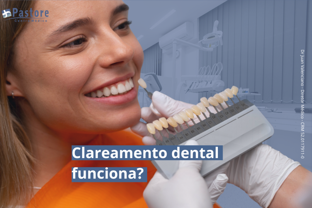 Clareamento Dental: como funciona, quem pode fazer e quais são os resultados