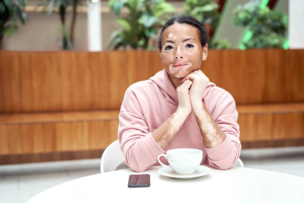 Uma mulher com vitiligo