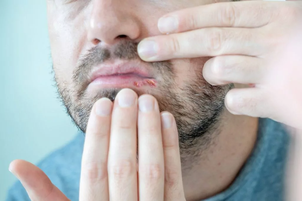 Você sabia que mais de 90% dos brasileiros têm o vírus da herpes?