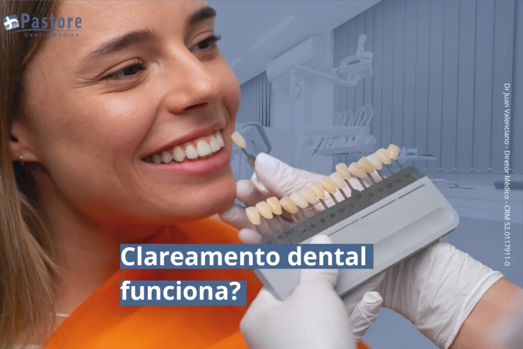 Clareamento Dental: como funciona, quem pode fazer e quais são os resultados